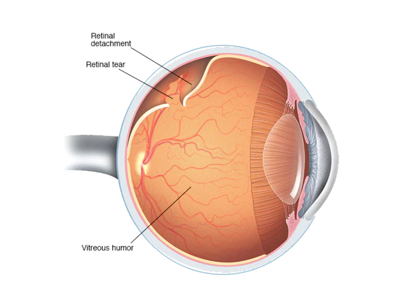 medical-&-surgical-retina-services-in-kollam