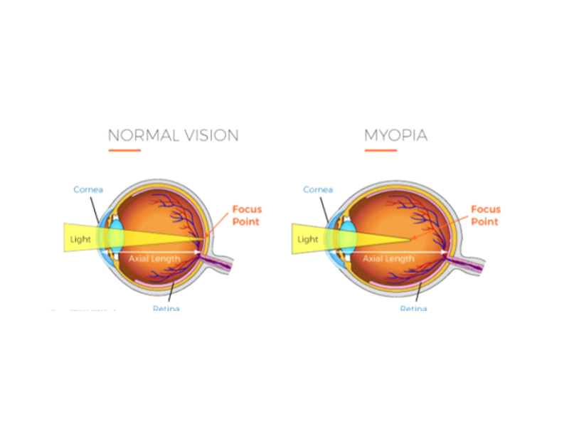 myopia-clinic-in-kollam