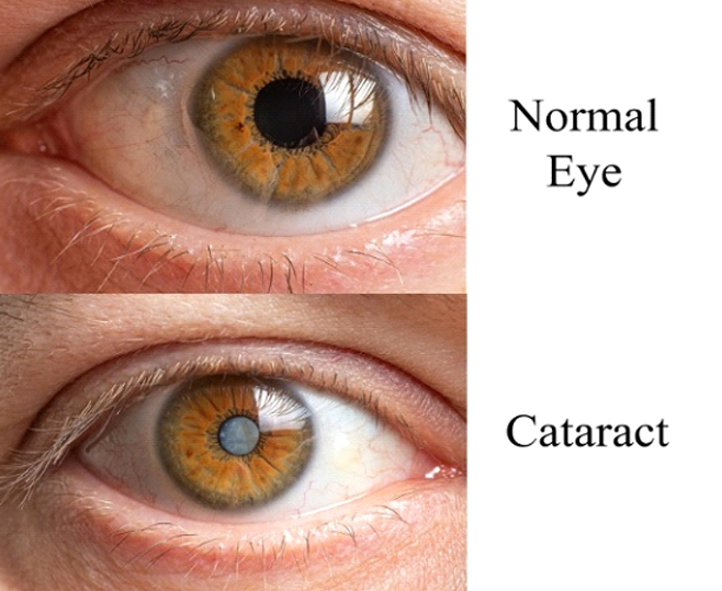 Cataract service