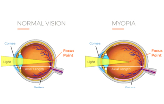Myopia